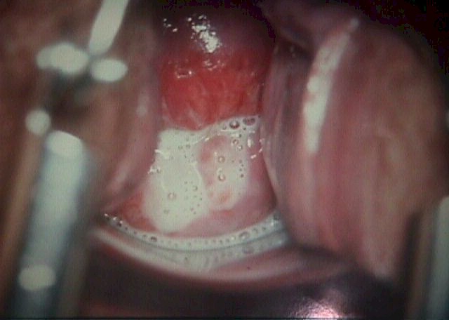 Trichomonas