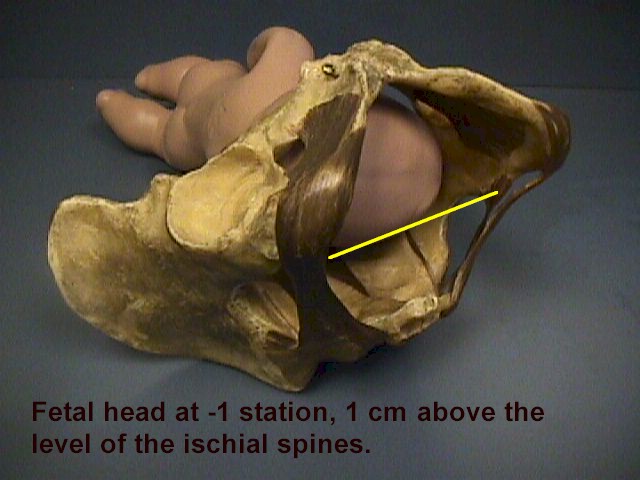 Ischial Spine Pain Pregnancy