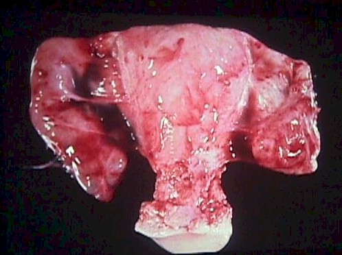 Hysterectomy specimen with severe PID