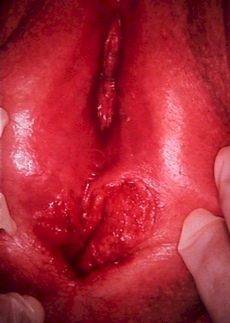 Vulvar Cancer