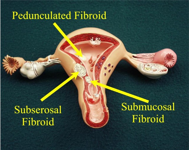 the same or reduced and do not stimulate fibroid growth