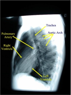 Normal Labled Lateral Chest X-ray