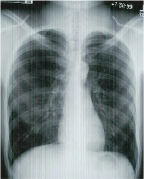Normal AP Chest X-ray