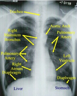 Normal Labled AP Chest X-ray