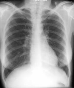 Left Lower Lobe Pneumonia, Anterior Segment