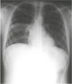 Right Lower Lobe Pneumonia, Superior Segment