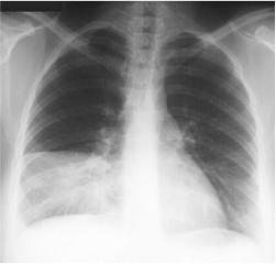 Right Middle Lobe Pneumonia