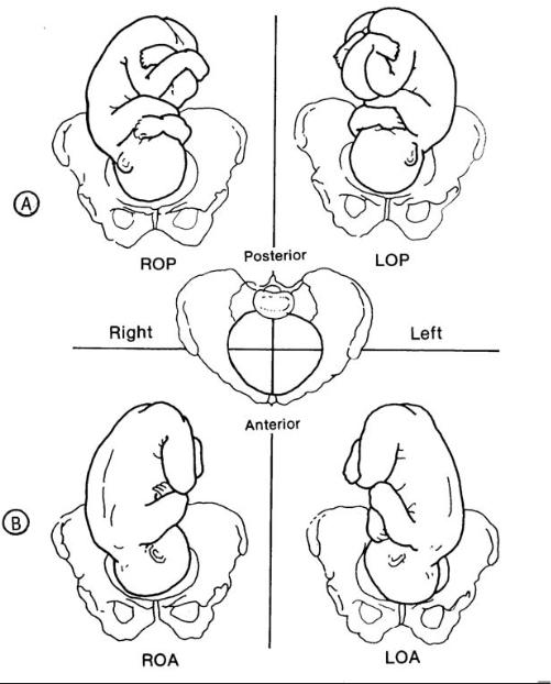 Transverse Fetal Lie