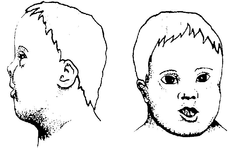 Signs And Symptoms Of Down Syndrome In Infants