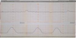 Dystocia Hypertonic Labor Pattern - IRSC Faculty Web Server