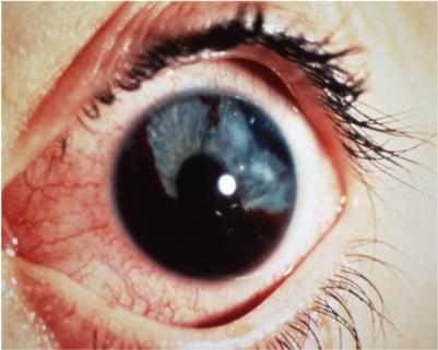 Hyphema Of Iris