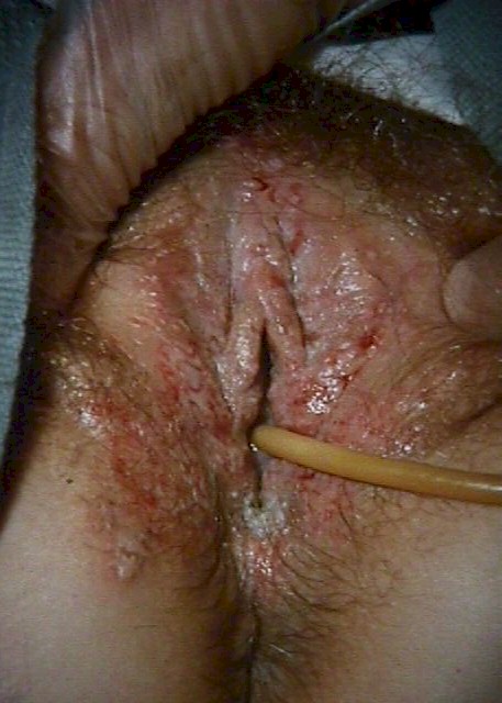 General Herpes Picture