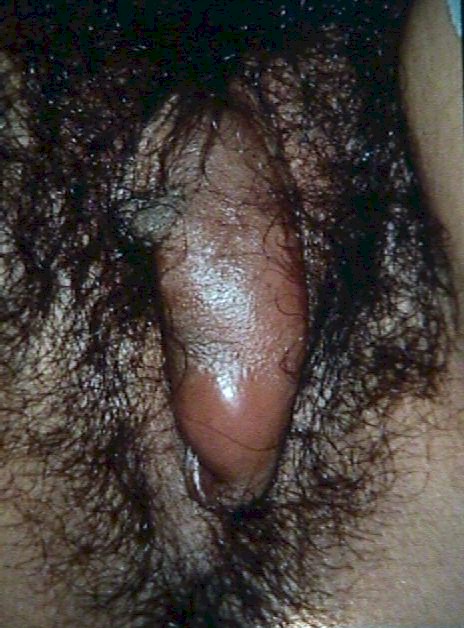 cysts on labia. of the labia in contrast