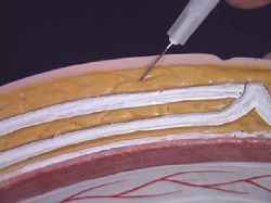 subcutaneous injection