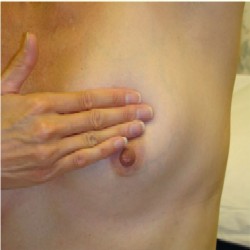 Self Breast Exam