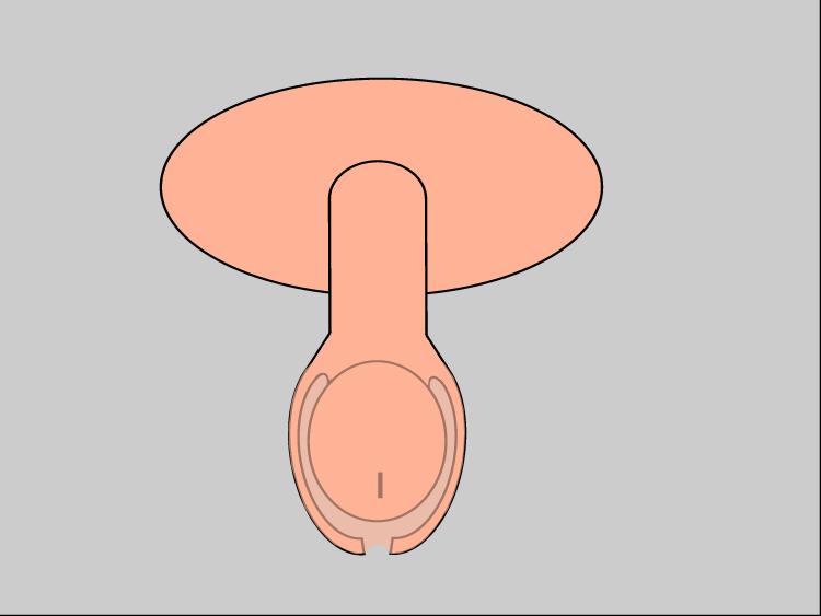 circumcision