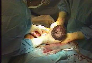 Delivery by cesarean section