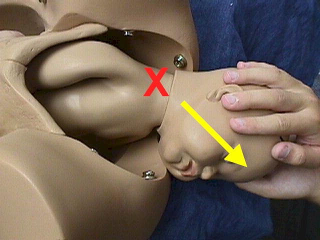 Excessive Downward Traction