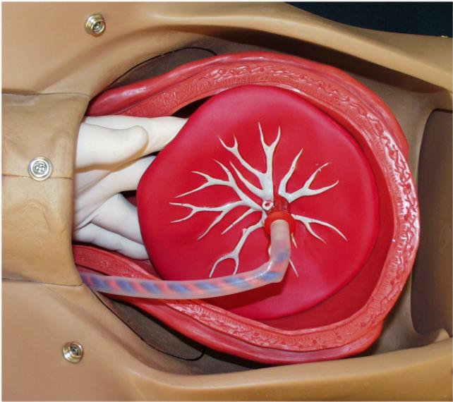 eparate the placenta from the uterus with a sweeping motion