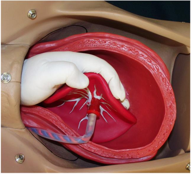 After the placenta is mostly separated, curl your palm around the bulk of it.
