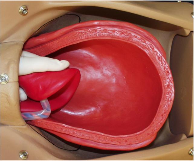 Continue to grasp the placenta as you remove it from the uterine cavity.