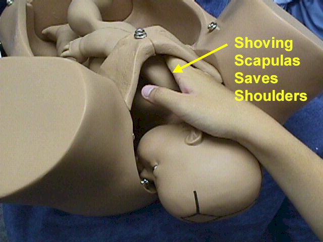 Shoving Scapulas Saves Shoulders