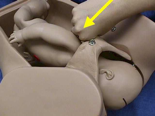 Suprapubic Pressure
