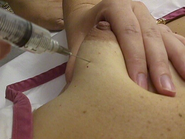 Aspiration Of Breast Cyst 10