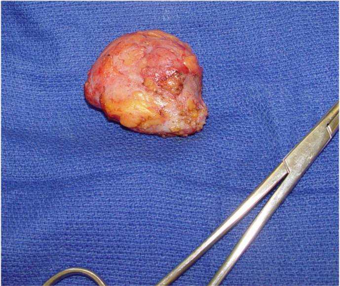 Excised Mass (Hemartoma: Benign)