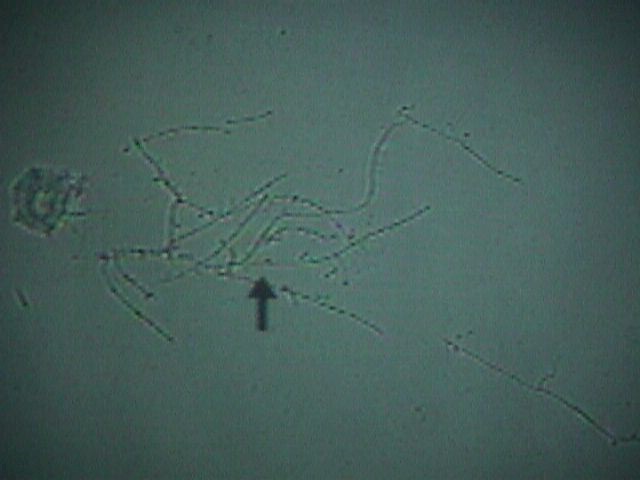 After the cell membranes are dissolved, the typical branching and budding yeast cells can be seen.