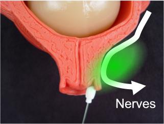 The nerves conducting the pain of labor pass next to the cervix. Blocking nerve conduction at this point blocks labor pain.