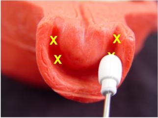 Inject a total of 20 cc of 1% Lidocaine into the lateral vaginal fornices, with injection sites of 10, 8, 2, and 4 o'clock (5 cc in each site).