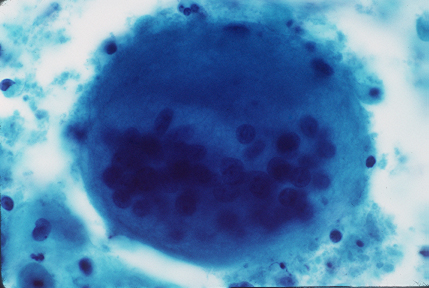 cervical atrophy