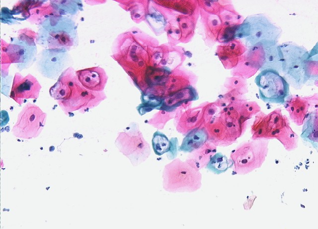 mild dysplasia