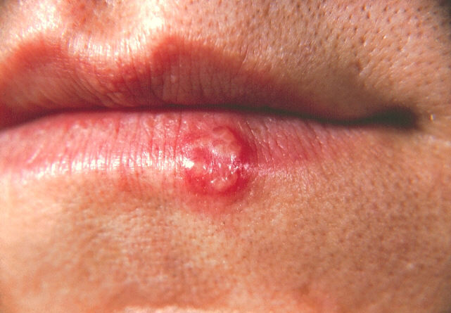 Herpes Simplex Type I