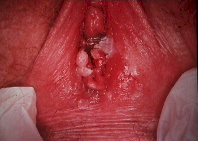 condyloma