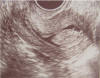 endometrial polyp