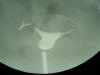 salpingogram