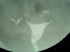 salpingogram