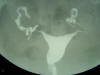 salpingogram