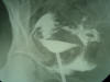 salpingogram