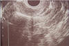 IUD