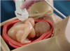 abdominal circumference