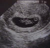 uterus