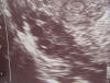 polycystic ovaries