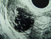 corpus luteum cyst