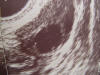 ovarian follicle