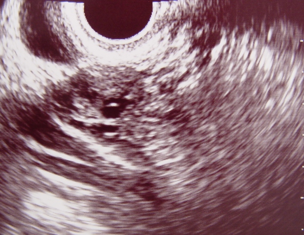 ovary