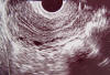 uterus longitudinal