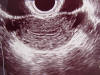 uterus transverse
